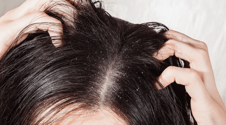 como acabar com a caspa