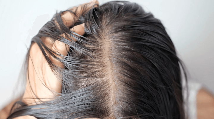 cabelo oleoso como tratar